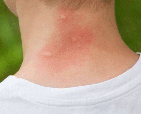 MoskiZap™ Nature – Patch Répulsif Bio